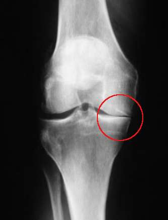Decreased joint space on one side of knee
