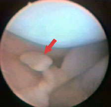 loose body in the knee joint