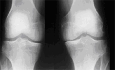 AP x-ray of knee