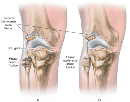 fibular collateral ligament reconstruction