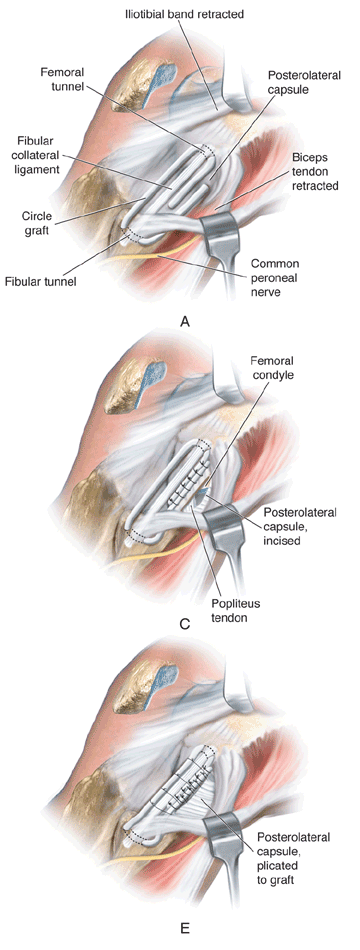 Femoral-fibular reconstruction