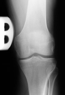 normal knee x-ray