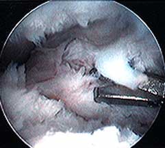 scar tissue inside knee