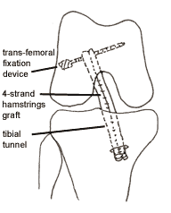 femoral transfixation