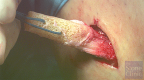 bone patellar-tendon bone allograft