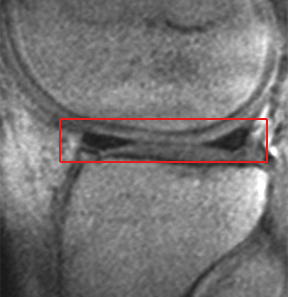MRI from the side showing intact meniscus