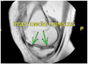 MRI showing regenerated meniscus