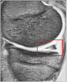 MRI showing tear of posterior horn