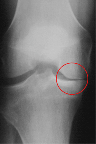X-ray showing reduced joint space on one side