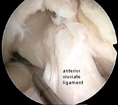 cruciate ligaments during arthroscopy