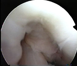 intercondylar notch of knee