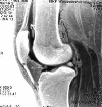 MRI of knee showing a plica