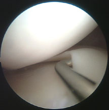 probing the meniscus