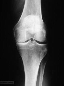 long leg x-ray