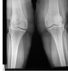 X-ray of valgus knees