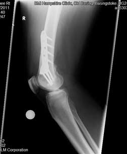 X-ray of varus knees