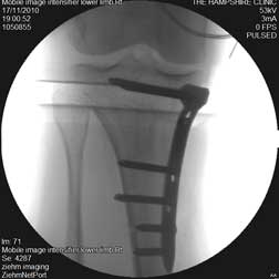 X-ray of varus knees