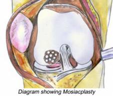 mosaicplasty