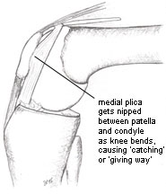 Image of a bent knee to show the medial plica being nipped between patella and femur