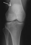 X-ray of front of knee