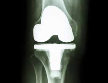 x-ray of total knee replacement