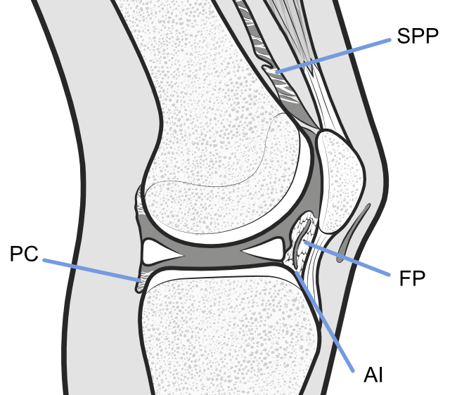 knee arthrofibrosis - labelled