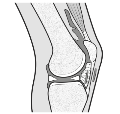normal knee, before onset of arthrofibrosis