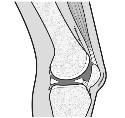 Advanced arthrofibrosis of the knee