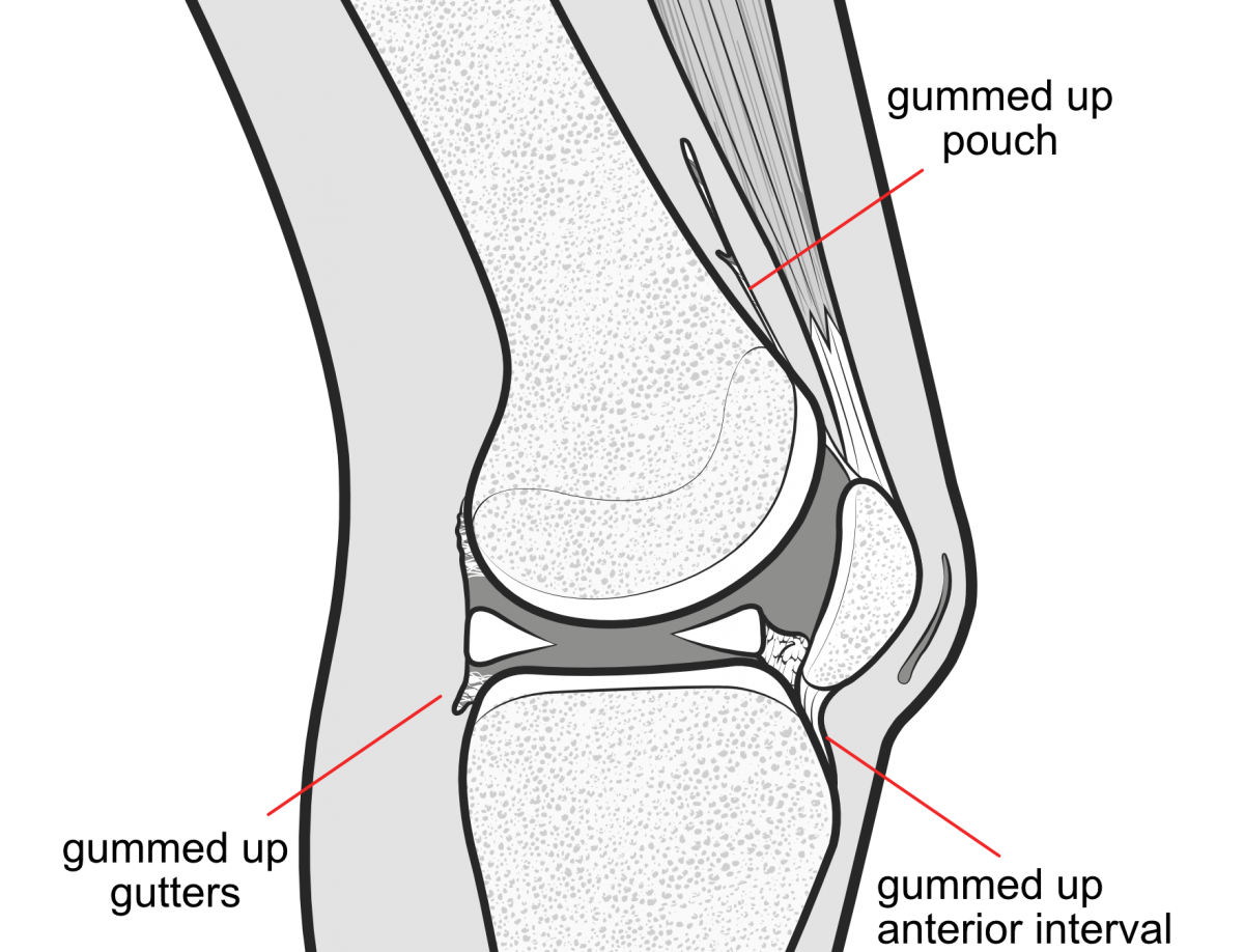 arthrofibrosis of the knee