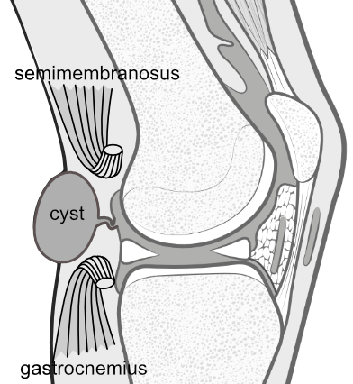 mechanism of baker's cyst