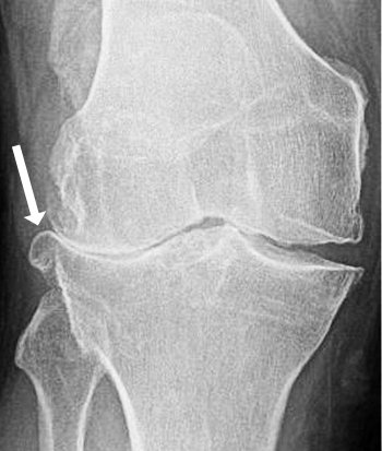Bone spur in osteoarthritic knee