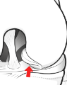 bucket-handle tear of meniscus