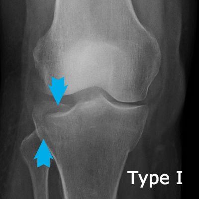 Type I tibial plateau fracture