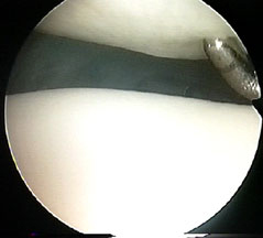 Outerbridge Grade I - Chondromalacia or softening of the patellar cartilage