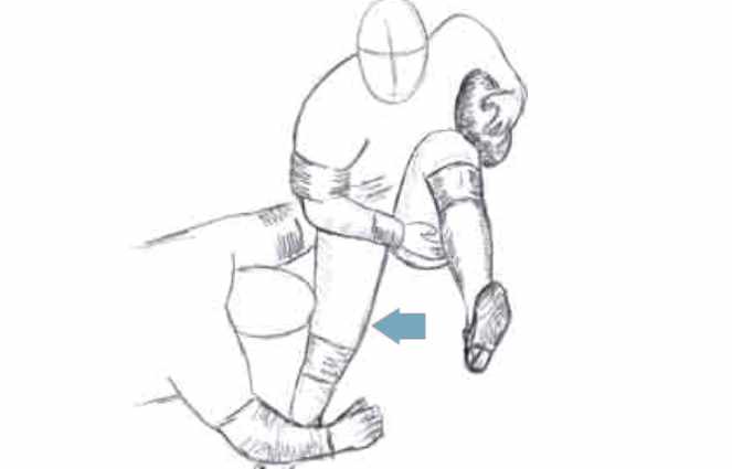 mechanism of injury of the medial collateral ligament