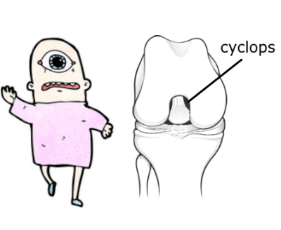 cyclops lesion of the knee