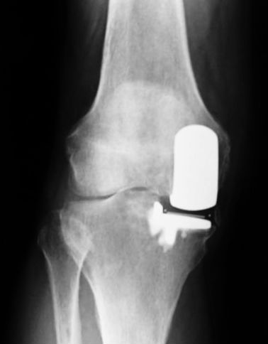 partial knee replacement 