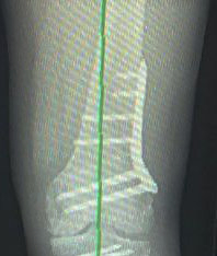 distal femoral osteotomy