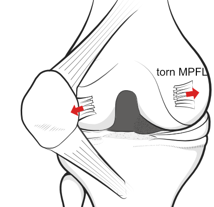 dislocation of the patella with torn MPFL