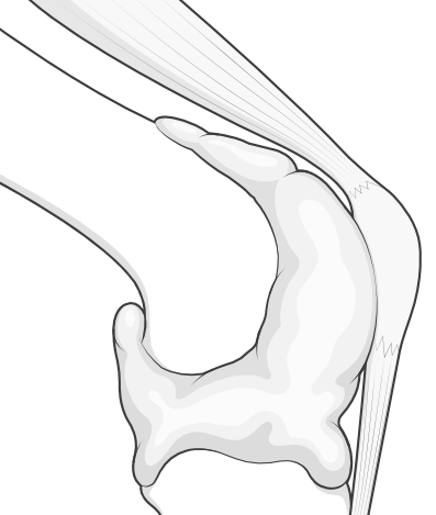 effusion of knee contained within joint capsule
