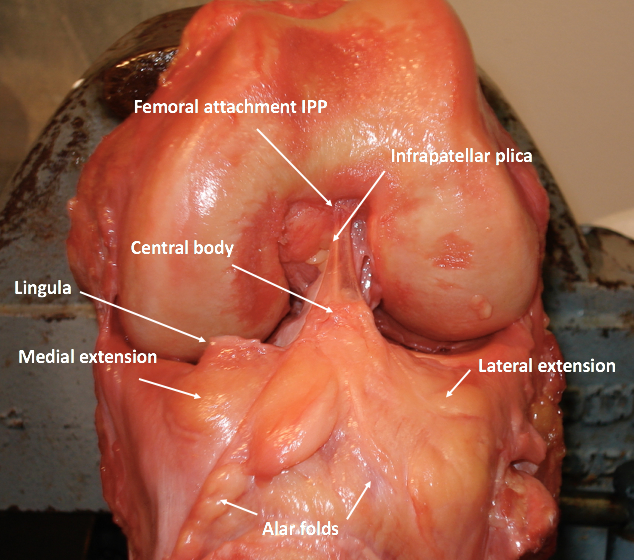 dissection of knee to show infrapatellar plica