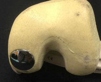 focal implant of femoral condyle