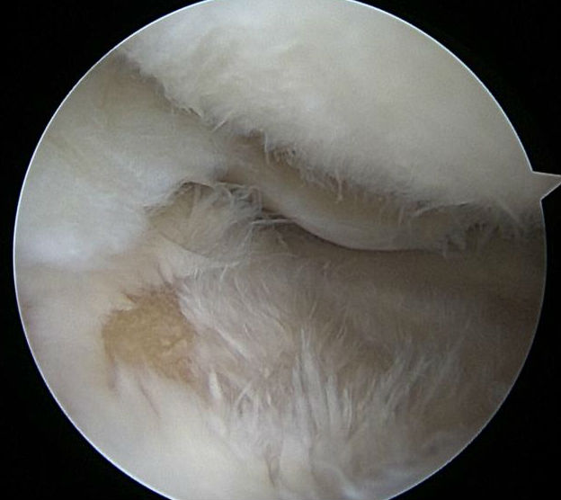Outerbridge Grade IV - patellar cartilage fibrillated with exposure of underlying bone in the tibia