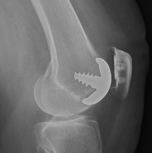 trochlear implant from the side plus patellar resurfacing