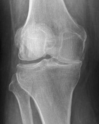 narrowed joint space on medial side
