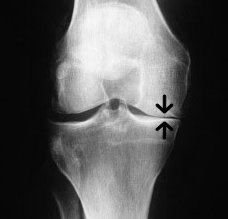 knee joint space narrowing on one side