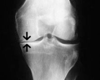 Joint space narrowing in the knee