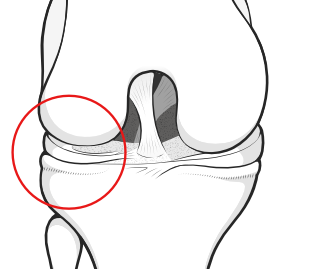 lateral compartment of the knee
