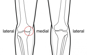 medial joint line thinning of the knee