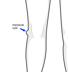 lateral meniscal cyst